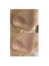 エミルカ 鹿児島店(EMILUCA)/毛穴洗浄