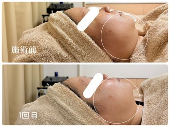 キーオブフェイス(Key of Face)/脂肪分解「RED SHOT」