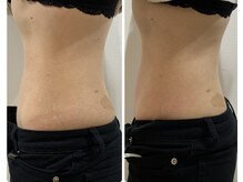 ルナート(Lunart)/美腸くびれモニター