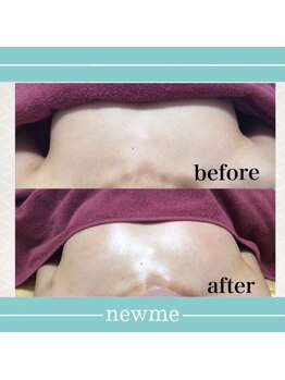ニュウミー 諏訪本店(newme)/最新機器NRでふっくら美バスト