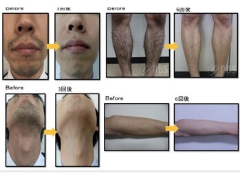 エルマナ(HERMANA)/効果実感光脱毛/全身脱毛/美肌