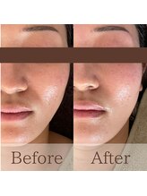 凪眠/小顔リンパフェイシャルの効果14