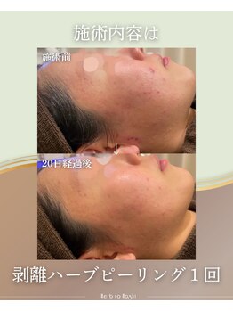 ハーブのほし/1回でハーブの力実感ニキビ減少