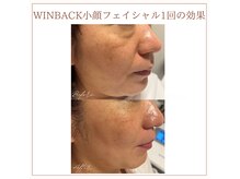 ソワン(Soin)の雰囲気（WINBACK1回の効果）