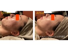 ロイヤリティ(ROYALTY)/ニキビ/お肌の凹凸/毛穴/美白