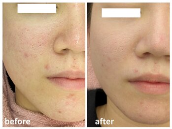 ラミーユ(La Miu)/WAX+ハーブピーリングで毛穴改善