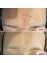 エミルカ 鹿児島店(EMILUCA)/ハーブピーリング