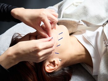 アロエベル(aloe Belle)/美容鍼