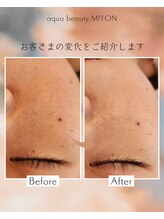 アクアビューティ ミヨン(Aqua beauty MIYON)/before &nbsp;&nbsp;after