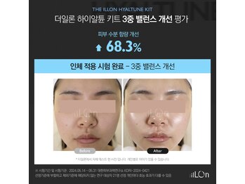 ラ ミュエル(La miel)の写真/【韓国で研修の元ご提供は当店だけ】ニキビケアにも◎スキンケア導入力が上がり艶肌に♪