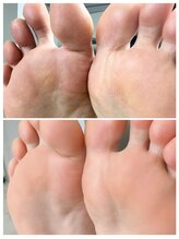 リンネ(Rinne)/角質ケアbefore→after