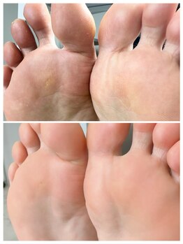 リンネ(Rinne)/角質ケアbefore→after