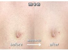 キュー(cue)/【メンズ】「胸下脱毛」施術事例