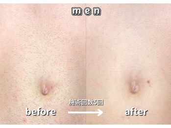 キュー(cue)/【メンズ】「胸下脱毛」施術事例