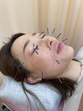 すみだバランス鍼灸整骨院 押上本院/目の疲れ・鼻の不調に美容鍼♪