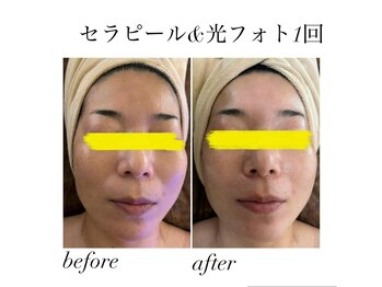 マーレン(Malen)/【セラピール】症例写真