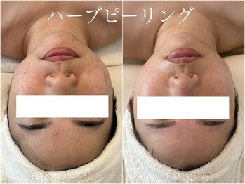 イム(I'm.)の写真/【ダウンタイムなしのハーブピーリング】肌荒れを繰り返さない素肌へ♪お肌が弱い方や凹凸肌に悩む方にも◎