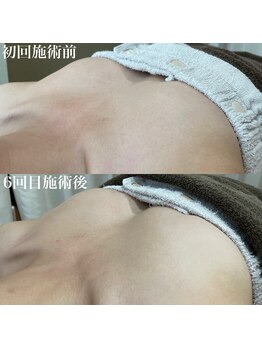 ウルル(ULuLu)/バストケア before after