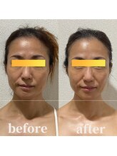 ロータス ビューティー(LOTUS Beauty)/小顔/左右差/トーンアップ