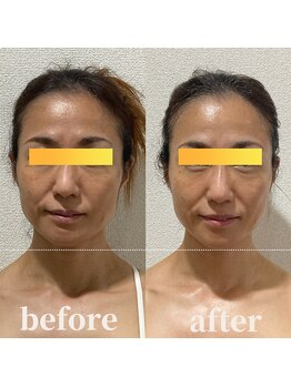 ロータス ビューティー(LOTUS Beauty)/小顔/左右差/トーンアップ