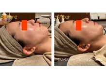 ロイヤリティ(ROYALTY)/ニキビ/お肌の凹凸/毛穴/美白