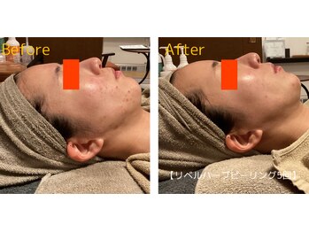 ロイヤリティ(ROYALTY)/ニキビ/お肌の凹凸/毛穴/美白