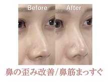 ラプリ 新宿店(Raplit)/隆鼻＋輪郭矯正40分10回