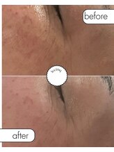 ルサンク(le cinq)/表情皺周りの小皺に注目