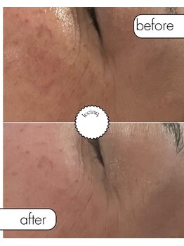 ルサンク(le cinq)/表情皺周りの小皺に注目