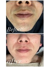 クラスペディア 嘉島店/メンズ髭脱毛ビフォー、アフター