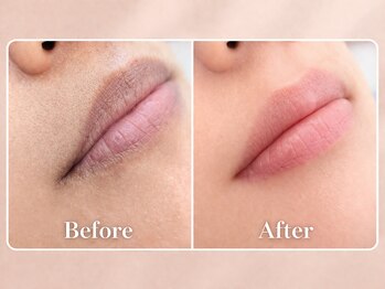 ワールドビューティー(World Beauty)の写真/【国家資格者施術】《半額モニター募集中》ローマピンクで話題!唇の黒ずみを桃色にする専門メラニンケア。