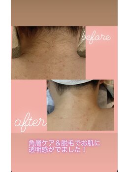 ビーザライト(Be the light)/☆こだわりの全身脱毛☆