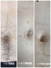 ボニータ(BONITA)/光脱毛