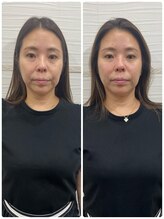 長寿鍼灸院 長寿整骨院/美容鍼25本の効果★小顔効果