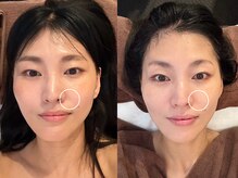 巡りサロン結希(ゆき)/頬、リフトアップ