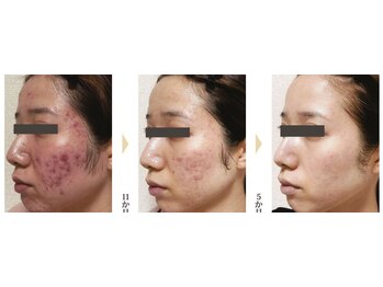 メディカルサロン ファン(FUN)/頑固な角栓・毛穴