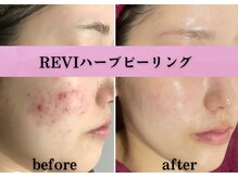エステレア(Esthelea)の雰囲気（皮むけ×初めての方も◎ニキビでお悩みの方はぜひお試し下さい★）