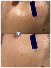 チェスタ/毛穴　クスミ 美白