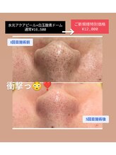 クレール 小山店(CLAIR)/【毛穴洗浄&ニキビ改善】
