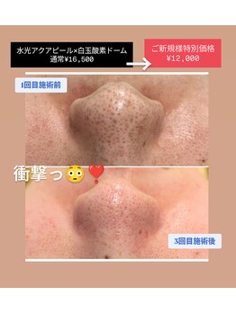 クレール 小山店(CLAIR)/【毛穴洗浄&ニキビ改善】