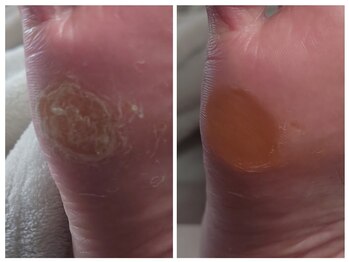 小指側の胼胝(タコ)