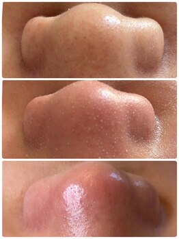 ユフラ(Juhla)/韓国式3D毛穴洗浄/黒ずみ毛穴