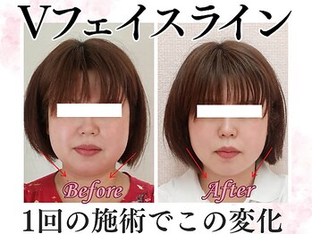 ジュピテール/小顔矯正 Before-After 松戸