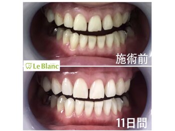 ルブラン 奈良店(Le Blanc)/印象変えるなら歯から!!