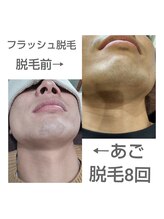 アンジェリーナ/メンズ脱毛/ヒゲ脱毛