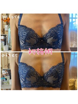 森の時計/症例写真:バスト編