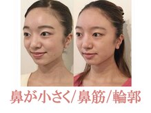 ラプリ 仙台店(Raplit stella)/隆鼻矯正+輪郭40分 10回