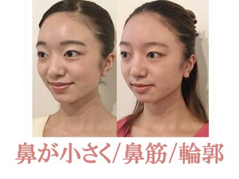 ラプリ 仙台店(Raplit stella)/隆鼻矯正+輪郭40分 10回