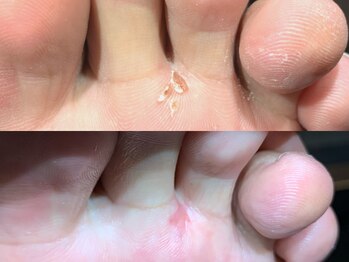 ドイツ式フットケア