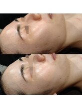 ボーソリューション(Beau-Solution)/【20代　サマー水光ピーリング】